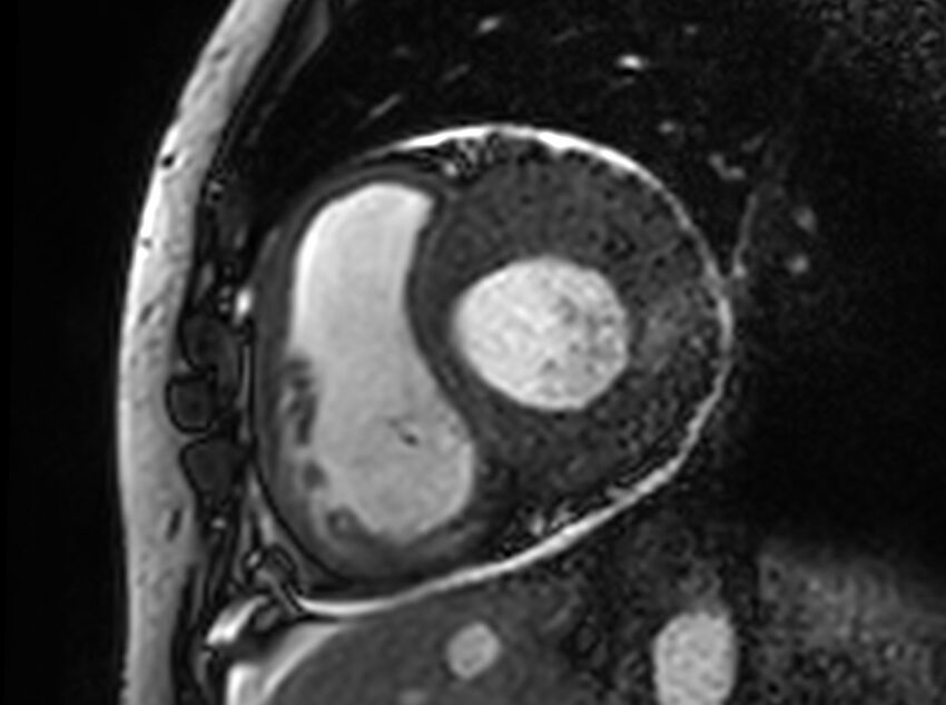 Cardiac amyloidosis (Radiopaedia 61600-69579 Short axis bSSFP 246).jpg