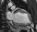 Cardiac sarcoidosis (Radiopaedia 39811-42243 B 8).jpg