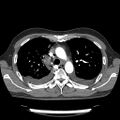 Cardiac tamponade (Radiopaedia 78607-91368 Axial C+ CTPA 23).jpg