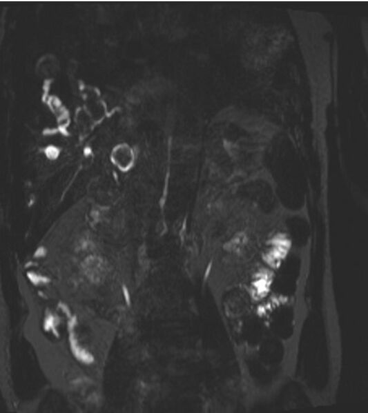 File:Caroli disease with medullary sponge kidney and nephrocalcinosis (Radiopaedia 10805-11251 F 1).jpg