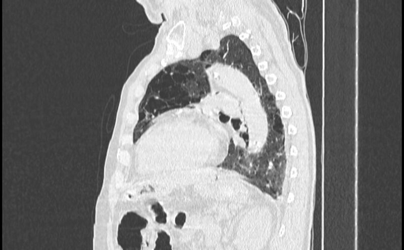 File:Cavitating bronchogenic carcinoma (Radiopaedia 44489-48162 Sagittal lung window 42).jpg