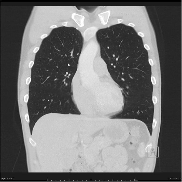File:Cavitating lung cancer (Radiopaedia 25796-25945 lung window 14).jpg