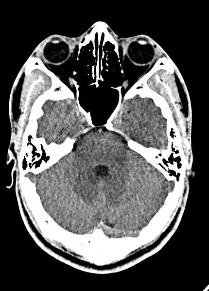 File:Cavum septum pellucidum and cavum vergae (Radiopaedia 77797-90060 Axial Brain Window 31).jpg