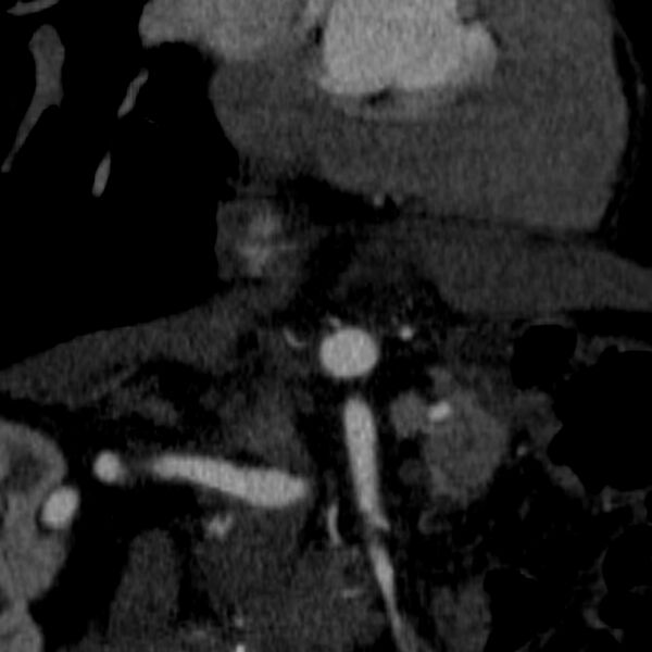 File:Celiac artery aneurysm (Radiopaedia 21574-21525 B 11).JPEG