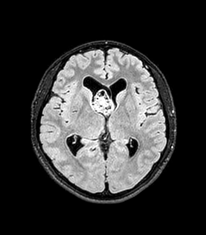 Central neurocytoma (Radiopaedia 79320-92380 Axial FLAIR 160).jpg