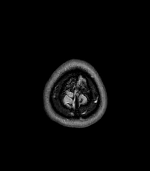 File:Central neurocytoma (Radiopaedia 79320-92380 Axial FLAIR 34).jpg