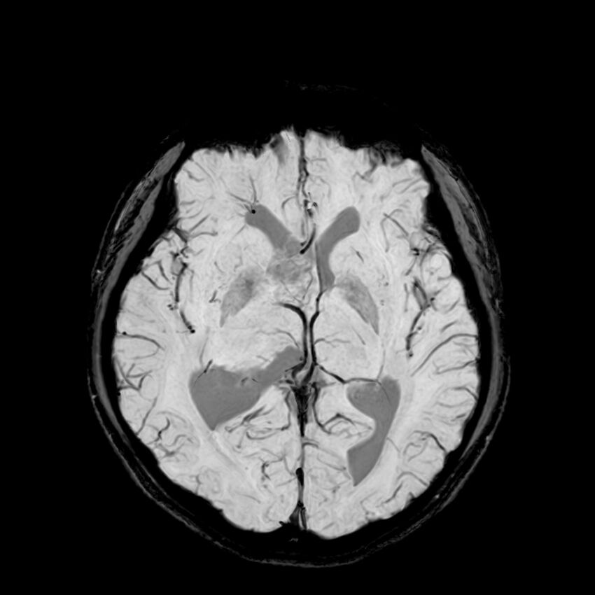 Central neurocytoma (Radiopaedia 79320-92380 Axial SWI 67).jpg