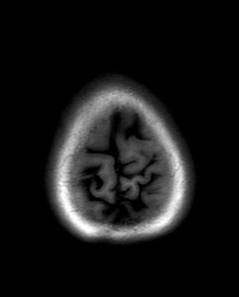 File:Cerebellar abscess (Radiopaedia 73727-84563 Axial T1 31).jpg
