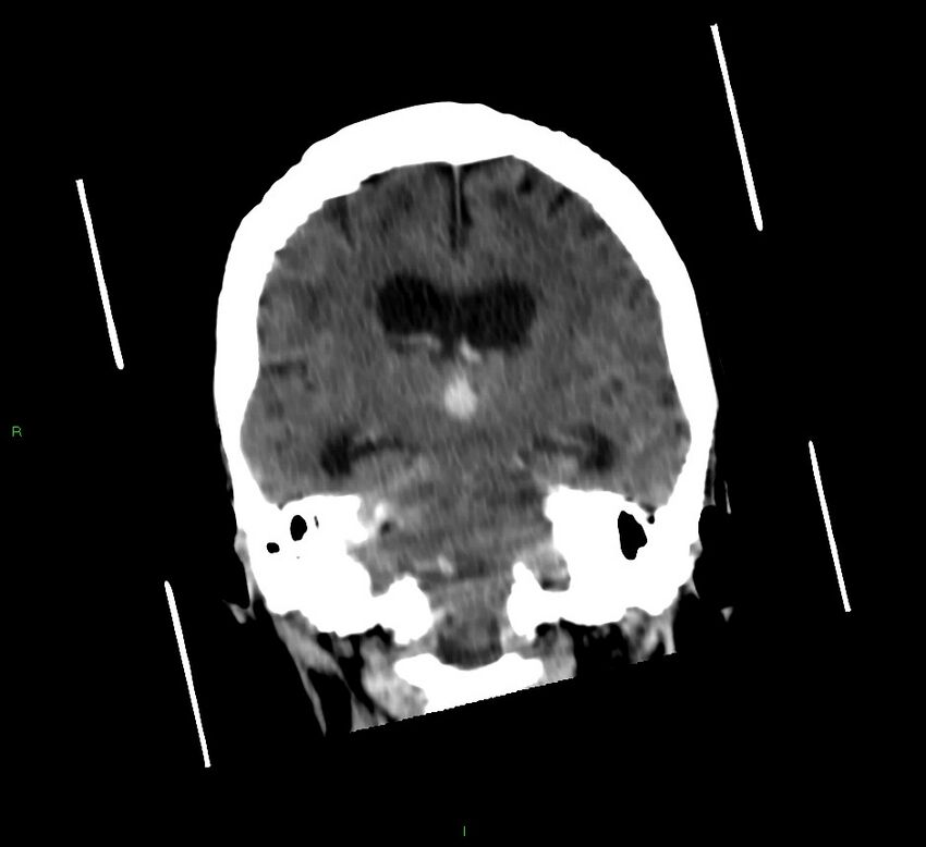 Cerebellar hemorrhage (Radiopaedia 58792-66026 Coronal non-contrast 31).jpg