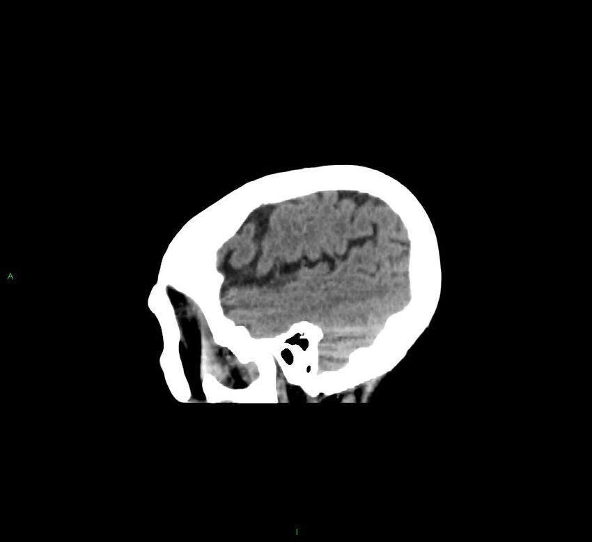Cerebellar hemorrhage (Radiopaedia 58793-66027 C 43).jpg