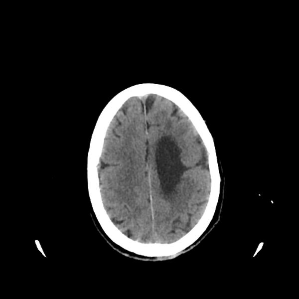 File:Cerebellar metastasis - lung tumor (Radiopaedia 69317-79145 Axial non-contrast 29).jpg