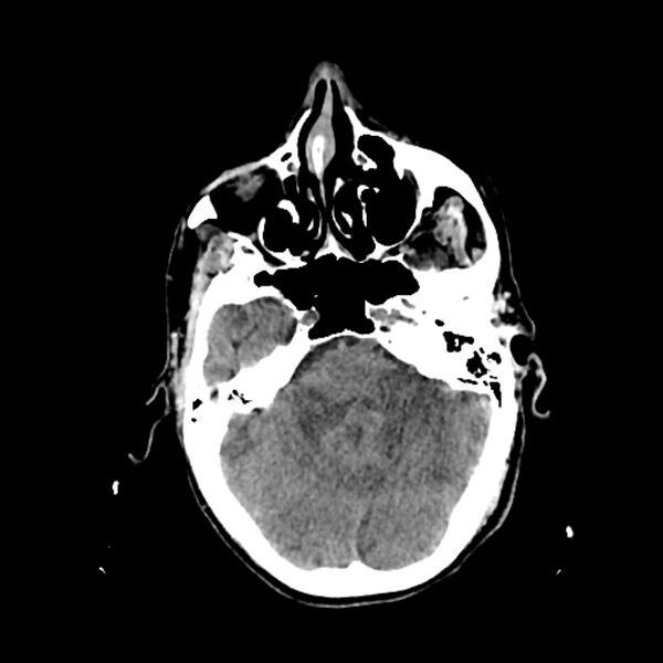 File:Cerebellar metastasis - lung tumor (Radiopaedia 69317-79145 Axial non-contrast 9).jpg