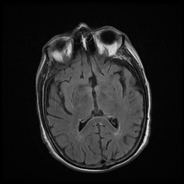 File:Cerebellar metastasis - lung tumor (Radiopaedia 69317-79147 Axial FLAIR 10).jpg