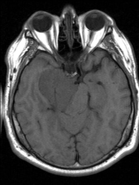 File:Cerebellopontine angle meningioma (Radiopaedia 24459-24764 Axial T1 8).jpg