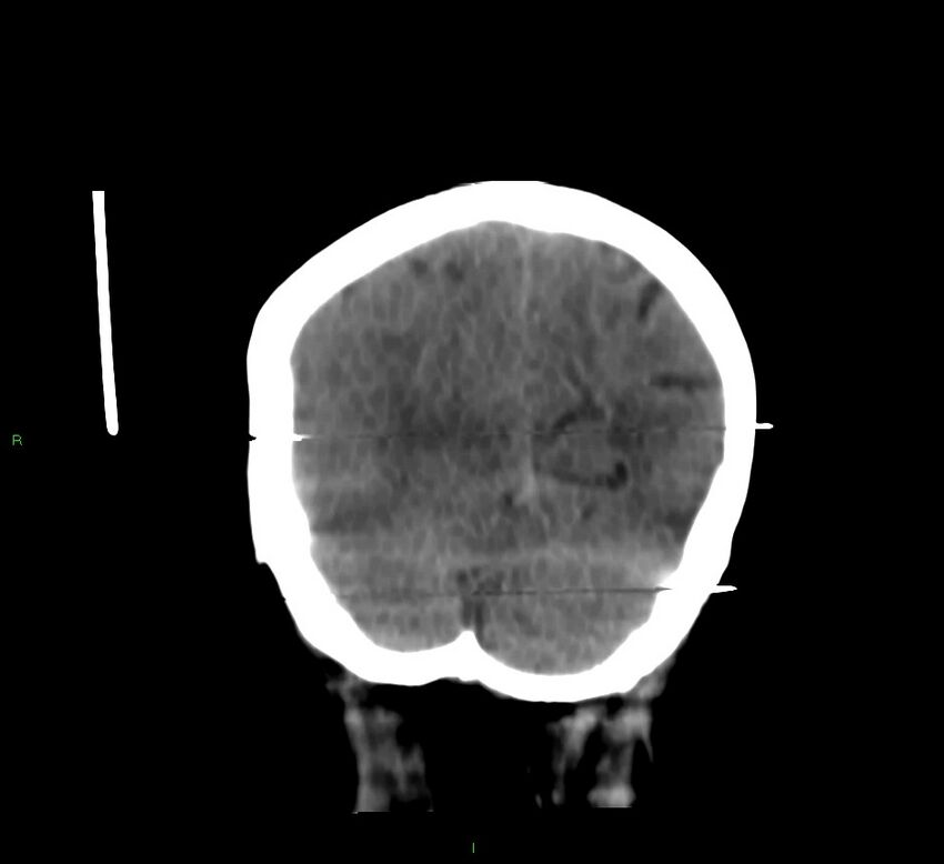 Cerebral amyloid angiopathy-associated lobar intracerebral hemorrhage (Radiopaedia 58377-65514 Coronal non-contrast 15).jpg