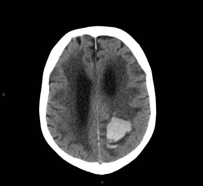 File:Cerebral amyloid angiopathy-associated lobar intracerebral hemorrhage (Radiopaedia 58530-65688 Axial non-contrast 16).jpg