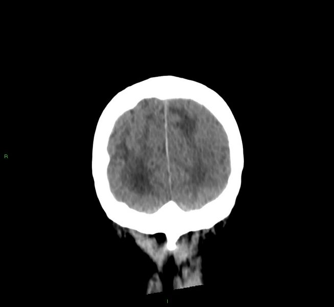 File:Cerebral amyloid angiopathy-associated lobar intracerebral hemorrhage (Radiopaedia 58530-65688 Coronal non-contrast 12).jpg