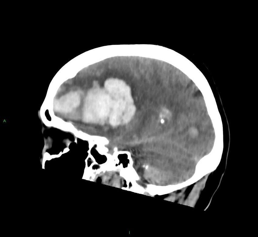 Cerebral amyloid angiopathy-associated lobar intracerebral hemorrhage (Radiopaedia 58752-65973 C 33).jpg