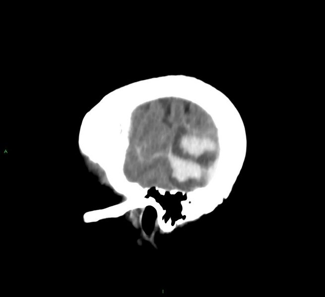 File:Cerebral amyloid angiopathy-associated lobar intracerebral hemorrhage (Radiopaedia 58757-65978 C 47).jpg