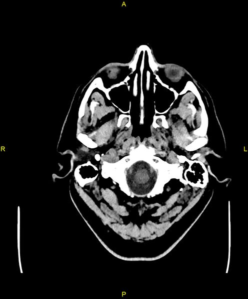 File:Cerebral autosomal dominant arteriopathy with subcortical infarcts and leukoencephalopathy (CADASIL) (Radiopaedia 86108-102051 Axial non-contrast 4).jpg