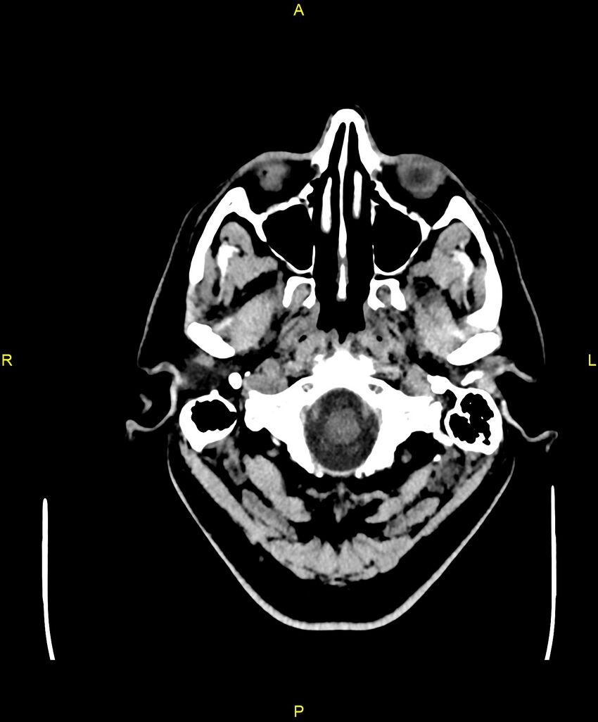 Cerebral autosomal dominant arteriopathy with subcortical infarcts and leukoencephalopathy (CADASIL) (Radiopaedia 86108-102051 Axial non-contrast 4).jpg