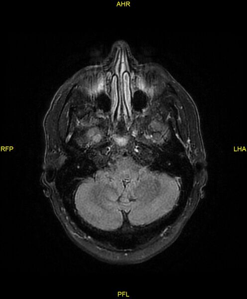 File:Cerebral autosomal dominant arteriopathy with subcortical infarcts and leukoencephalopathy (CADASIL) (Radiopaedia 86108-102054 Axial FLAIR 7).jpg