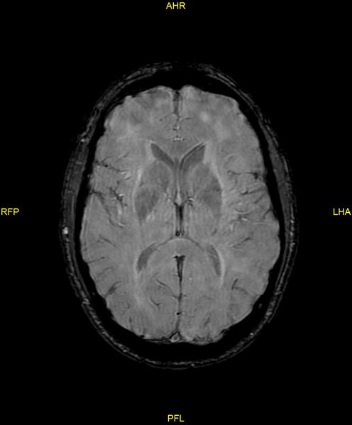 File:Cerebral autosomal dominant arteriopathy with subcortical infarcts and leukoencephalopathy (CADASIL) (Radiopaedia 86108-102054 Axial SWI 60).jpg