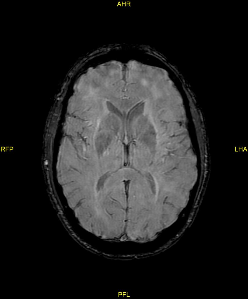 Cerebral autosomal dominant arteriopathy with subcortical infarcts and leukoencephalopathy (CADASIL) (Radiopaedia 86108-102054 Axial SWI 60).jpg