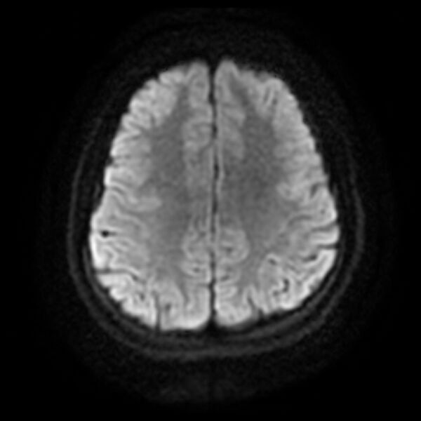 File:Cerebral cavernous malformation (Radiopaedia 44301-47942 Axial DWI 15).jpg