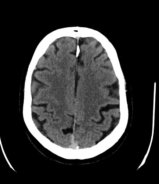 File:Cerebral dural venous sinus thrombosis (Radiopaedia 86514-102575 Axial non-contrast 32).jpg
