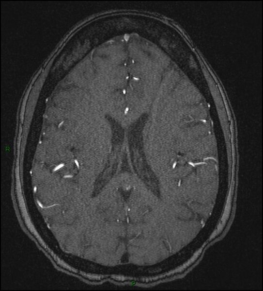 File:Cerebral fat embolism (Radiopaedia 35022-36525 Axial TOF 128).jpg