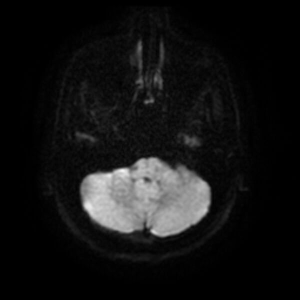File:Cerebral fat embolism (Radiopaedia 37510-39363 Axial DWI 7).jpg