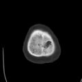 Cerebral hemorrhagic contusions (Radiopaedia 23145-23188 Axial bone window 55).jpg