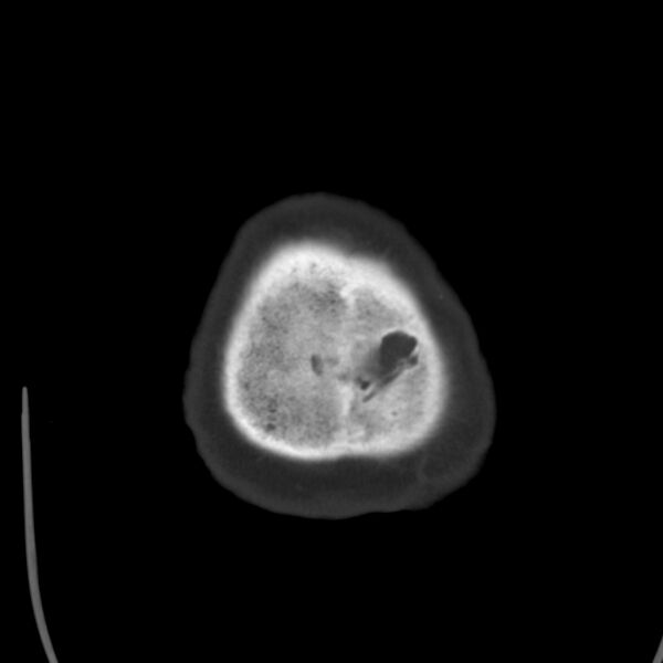 File:Cerebral hemorrhagic contusions (Radiopaedia 23145-23188 Axial bone window 55).jpg