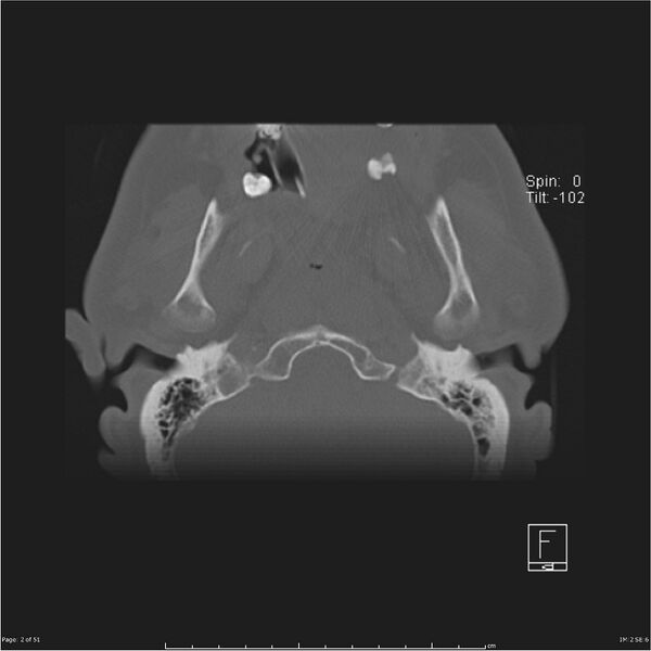 File:Cerebral hemorrhagic contusions and cervical spine fractures (Radiopaedia 32865-33841 C 2).jpg