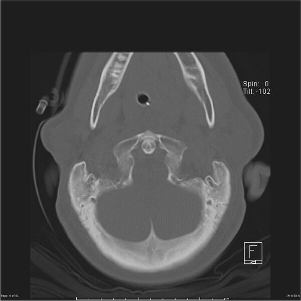 File:Cerebral hemorrhagic contusions and cervical spine fractures (Radiopaedia 32865-33841 C 6).jpg