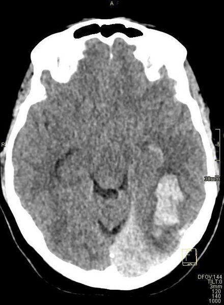File:Cerebral venous sinus thrombosis (Radiopaedia 91329-108965 Axial non-contrast 21).jpg