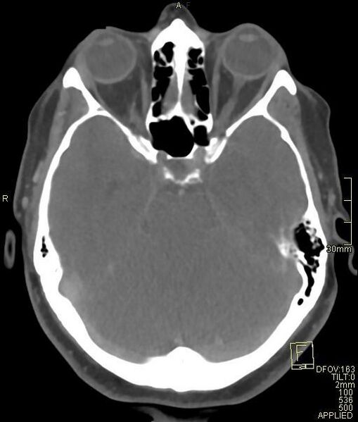 File:Cerebral venous sinus thrombosis (Radiopaedia 91329-108965 Axial venogram 29).jpg