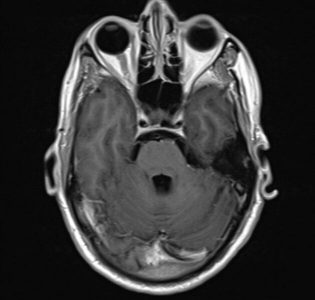 File:Cerebral venous thrombosis (Radiopaedia 71207-81504 Axial T1 C+ 8).jpg