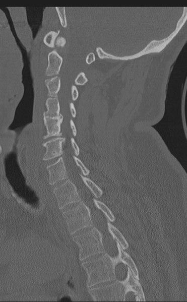 File:Cervical canal stenosis - OPLL and osteophytes (Radiopaedia 47329-51910 Sagittal bone window 32).png