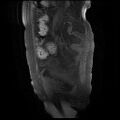 Cervical carcinoma (Radiopaedia 78847-91705 Sagittal T1 fat sat 13).jpg