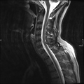 Cervical dural CSF leak on MRI and CT treated by blood patch (Radiopaedia 49748-54995 Sagittal T2 7).png