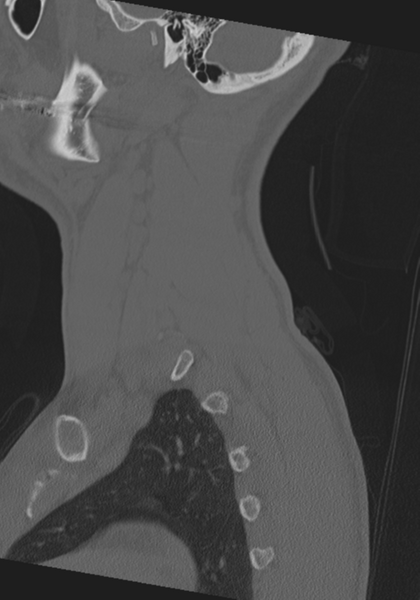 File:Cervical intercalary bone (Radiopaedia 35211-36748 Sagittal bone window 12).png
