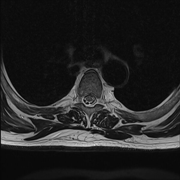 File:Cervical tumor-like myelopathy due to Type V dAVF (Radiopaedia 82461-96604 D 14).jpg