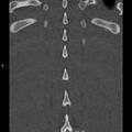 Chance fracture (Radiopaedia 36521-38081 Coronal bone window 57).jpg