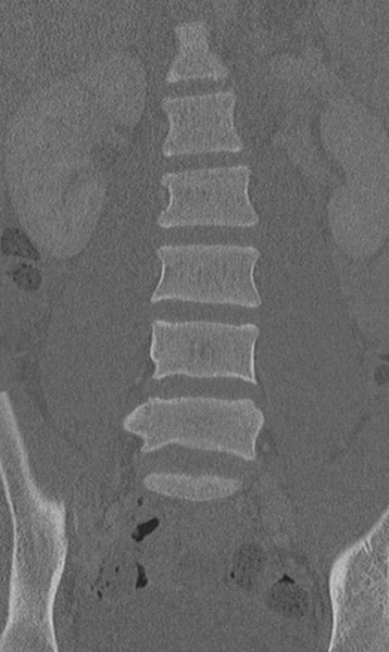 File:Chance fracture (Radiopaedia 40360-42912 Coronal bone window 25).png