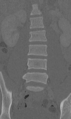 Chance fracture (Radiopaedia 40360-42912 Coronal bone window 25).png