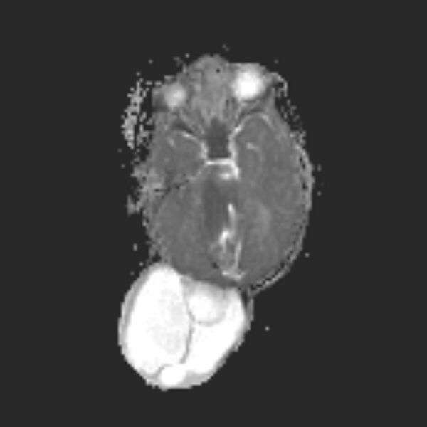 File:Chiari III malformation with occipital encephalocele (Radiopaedia 79446-92559 Axial ADC 11).jpg