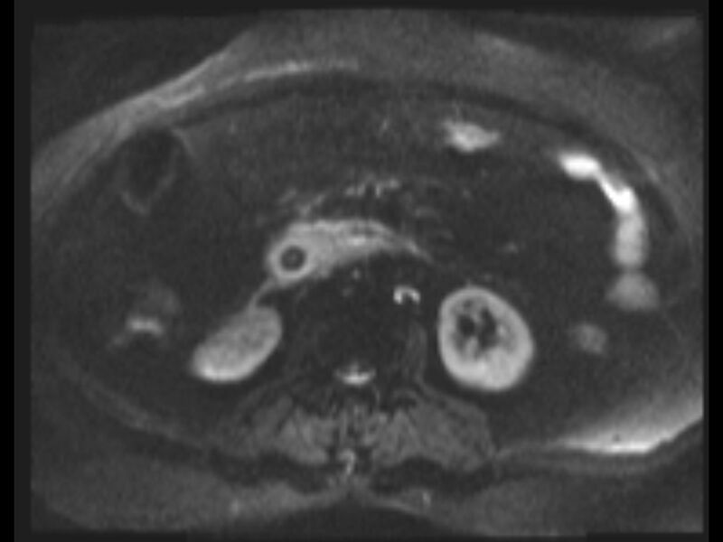 File:Choledocholithiasis causing intrahepatic biliary duct dilation (Radiopaedia 39908-42369 Axial T2 SPAIR 27).jpg