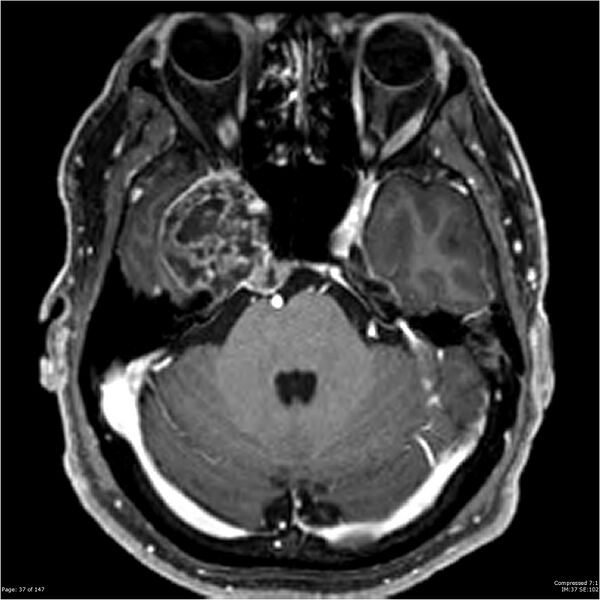 File:Chondrosarcoma of skull base- grade II (Radiopaedia 40948-43654 Axial T1 C+ 25).jpg
